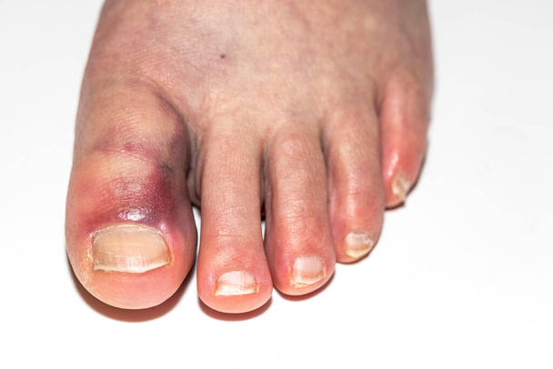 Vista cercana del pie dañado con moretones en el dedo gordo del pie. Concepto de lesiones. - Foto, imagen