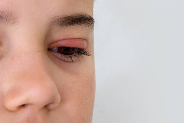Çocuk gözü stye. Oftalmik bulaşıcı hastalık hordeolum - Fotoğraf, Görsel