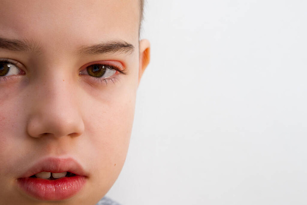 Çocuk gözü stye. Oftalmik bulaşıcı hastalık hordeolum - Fotoğraf, Görsel