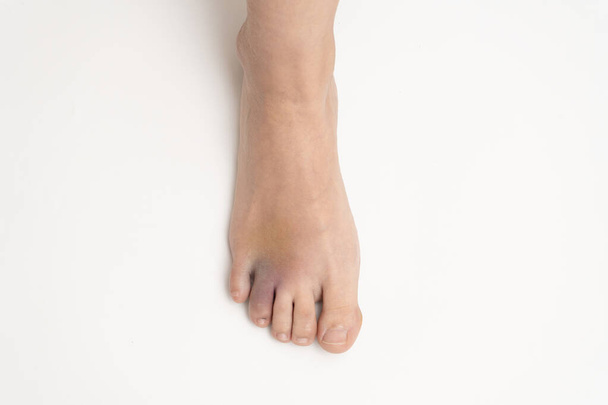 Брюс на нозі. Гематома після травми кільцевого пальця лівої ноги. Жіноча травмована кінцівка на білому тлі
. - Фото, зображення