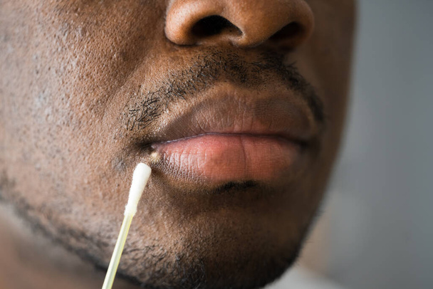 Herpes labiales doloridos tratamiento en la cara masculina - Foto, Imagen