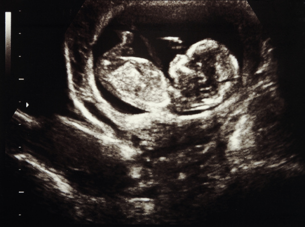 超音波妊娠 - 写真・画像