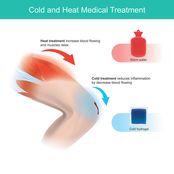 Hideg és meleg orvosi kezelés. Ez a grafika megmagyarázza az emberi láb 2 különböző fájdalom és sérülés közé tartozik az elsősegély kezelés - Vektor, kép