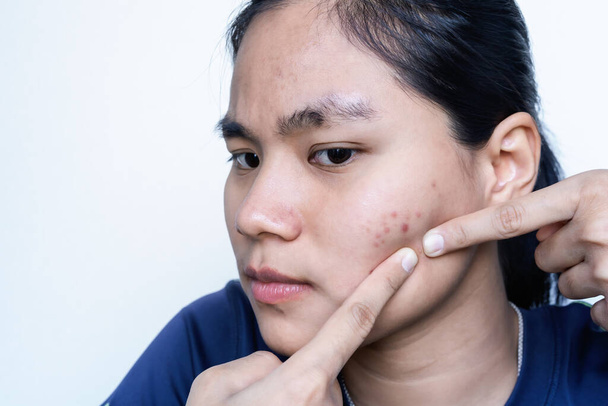 Portrait d'une jeune femme asiatique inquiète serrant son acné avec un fond blanc. Problème de peau de bouton, foyer sélectif sur les yeux avant. Adolescente serrant son visage par les doigts. Concept de soins de la peau. - Photo, image