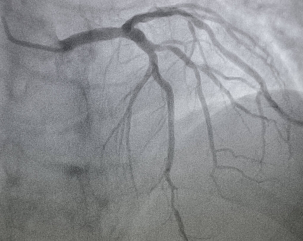 Coronary angiography , left coronary artery disease. - Photo, Image
