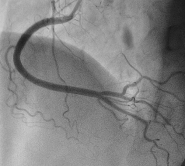 Coronary angiography , normal right coronary artery. - Photo, Image