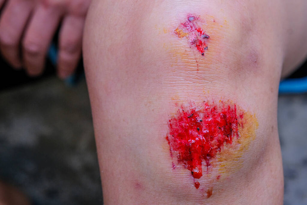 Een vrouw valt, veroorzaakt knieschaafwonden. - Foto, afbeelding