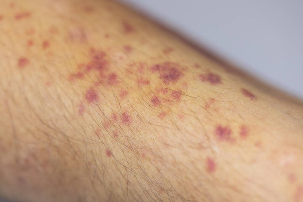 Fizyczny wygląd ramienia z raną jest spowodowany przez hemofilię, (Haemophiliais głównie dziedziczne zaburzenie genetyczne) - Zdjęcie, obraz