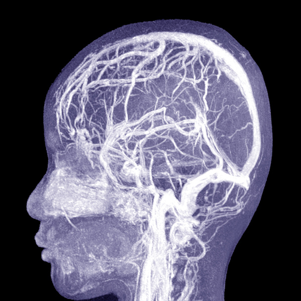 MRI THE BRAIN.Edema vasogênico perilesional moderado com desvio da linha média de 0,7 cm para o lado esquerdo.Conceito de imagem médica. - Foto, Imagem