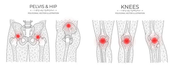 Ilustração vetorial poligonal da dor pélvica e no joelho. Modelos de doenças ortopédicas médicas - Vetor, Imagem