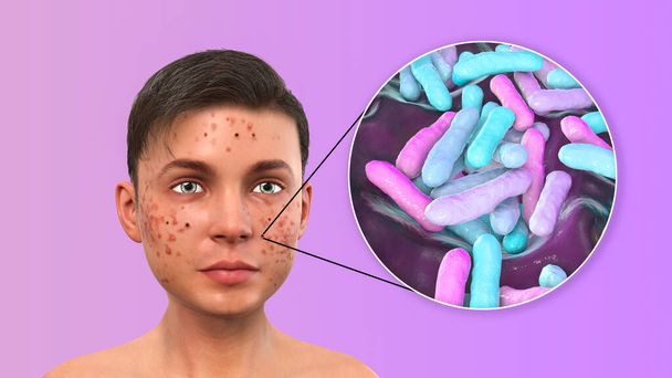 Acné vulgaris chez un adolescent et vue rapprochée des bactéries Cutibacterium acnes, anciennement Propionibacterium acnes, associées au développement de l'acné, illustration 3D - Photo, image