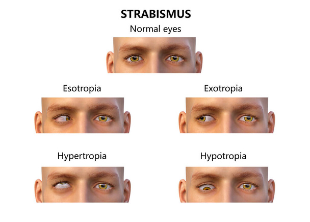 Estrabismo, ilustración 3D que muestra diferentes tipos de desviaciones oculares - Foto, imagen