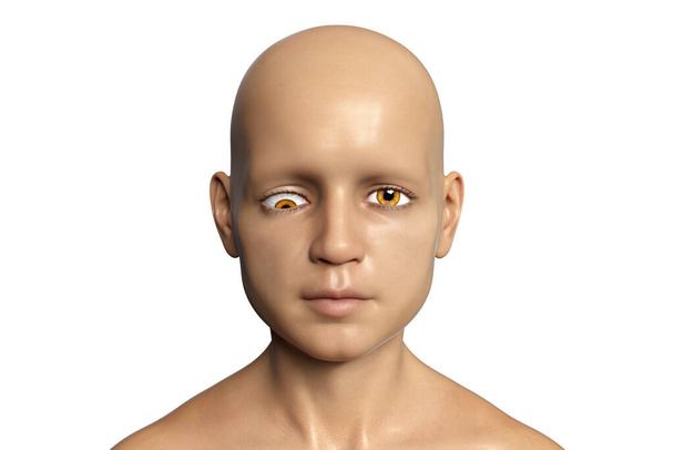 Strabisme chez l'enfant, illustration 3D montrant l'hypotropie, un type de déviation oculaire lorsque l'œil tourne vers le bas - Photo, image