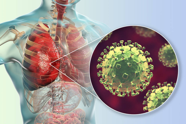 Nipah virus in lungs. A newly emerging bat-borne virus that causes acute respiratory illness and severe encephalitis, conceptual 3D illustration - Photo, Image