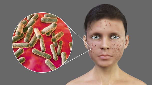 Acné vulgar en un adolescente y vista de cerca de bacterias Cutibacterium acnes, anteriormente Propionibacterium acnes, asociado con el desarrollo del acné, ilustración 3D - Foto, Imagen