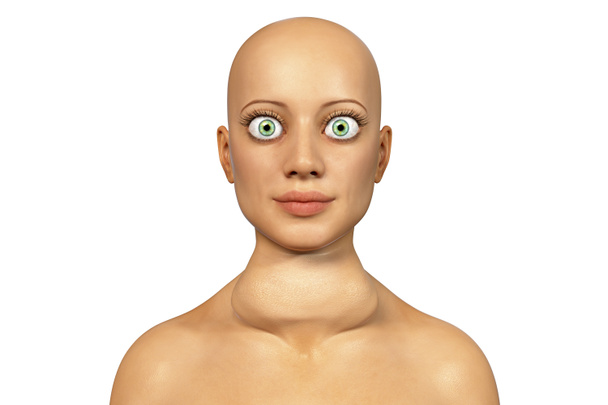 Schilddrüsenüberfunktion. 3D-Illustration zeigt ein Weibchen mit Graves 'Krankheit, auch als toxischer diffuser Kropf bekannt, das eine vergrößerte Schilddrüse und einen Exophthalmus hat - Foto, Bild