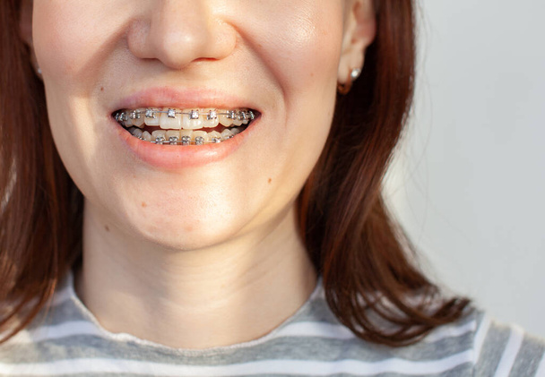 Zahnspange im lächelnden Mund eines Mädchens. Nahaufnahmen von Zähnen und Lippen. Glatte Zähne aus Zahnspangen. An den Zähnen von Gummibändern zum Anziehen der Zähne. Foto auf hellem, festem Hintergrund. - Foto, Bild