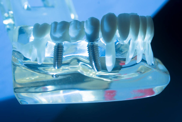Модель викладання стоматологічної імплантації зубів у металевих імплантатах, що показують зуби та ясна
. - Фото, зображення