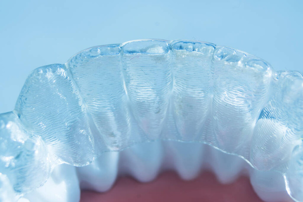 Moderne, unsichtbare Richtbügel, die von Zahnärzten zur Korrektur der Ausrichtung an den Zähnen verwendet werden. - Foto, Bild