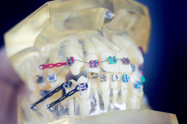 歯科歯アライナーブラケット歯茎や金属歯の矯正器を示す学生モデルを教える. - 写真・画像