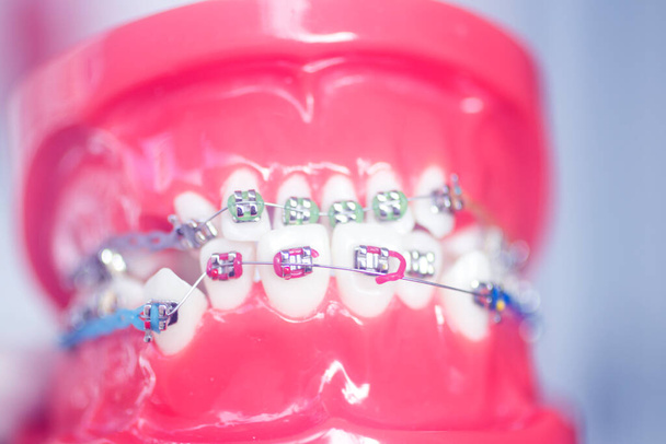 Dentista staffa allineatore insegnamento modello studente che mostra gengive e raddrizzatori di denti in metallo. - Foto, immagini