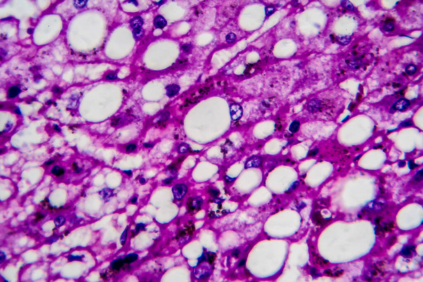 Гістопатологія алкогольного гепатиту, легкий мікрограф, фото під мікроскопом. Високе збільшення
 - Фото, зображення
