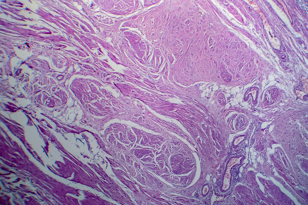 Carcinoma a cellule transizionali della vescica, microscopio leggero, foto al microscopio - Foto, immagini