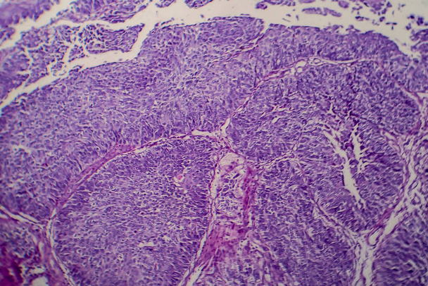 Blaas transitie celcarcinoom, licht micrograaf, foto onder microscoop - Foto, afbeelding