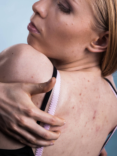 Health problem, skin diseases. Young woman showing her back with acne, red spots. Teen girl scratching her shoulder with pimples. - Фото, зображення