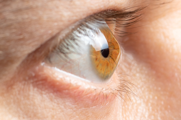 Keratoconus van het oog, 4e graad. Contortie van het hoornvlies in de vorm van een kegel, verslechtering van het gezichtsvermogen, astigmatisme. Macro close-up. - Foto, afbeelding