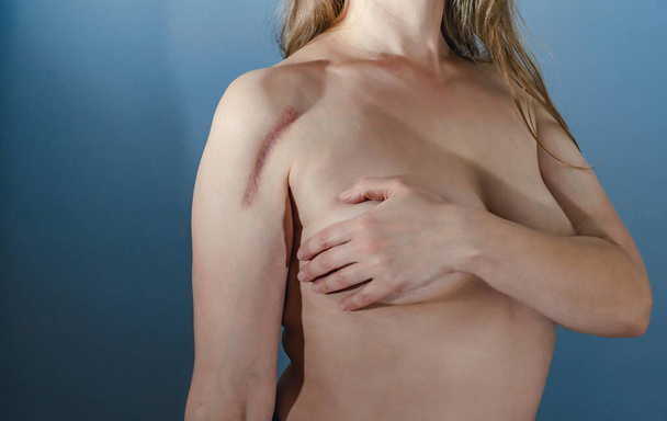 Женщина прикрывает грудь рукой, шрам на плече - Фото, изображение