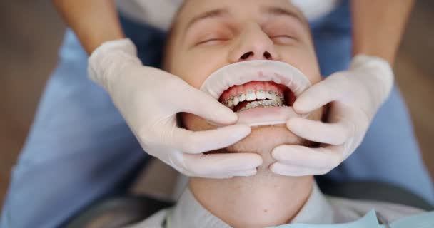 Paciente con aparatos dentales durante un tratamiento de ortodoncia - Metraje, vídeo