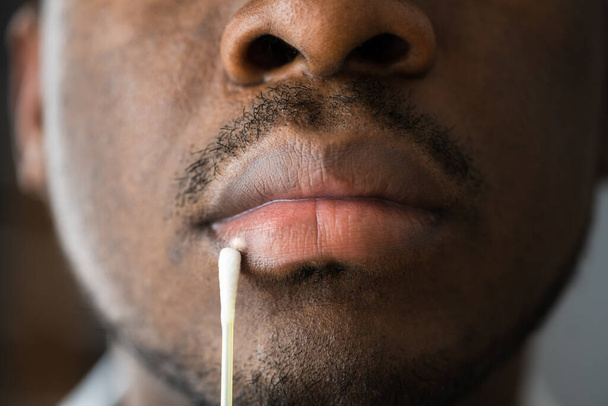 Sore Herpes Lips Treatment On Male Face - Foto, imagen