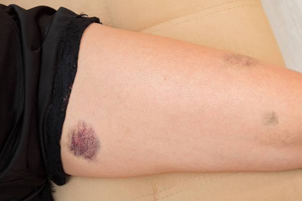 gamba femminile con lividi blu e rosa - Foto, immagini