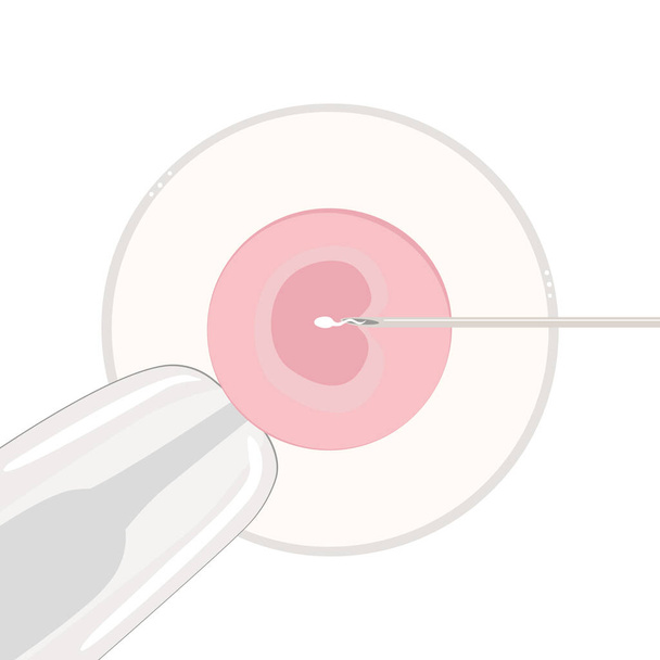 Plochá vektorová ilustrace oplodnění in vitro. IVF. Buňka pod mikroskopem. Pipeta drží vejce a sperma vytéká z jehly. Zblízka na bílém pozadí. - Vektor, obrázek