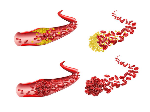 Набір вен з тромбом крові, що зупиняє потік еритроцитів. Ілюстрація
 - Фото, зображення