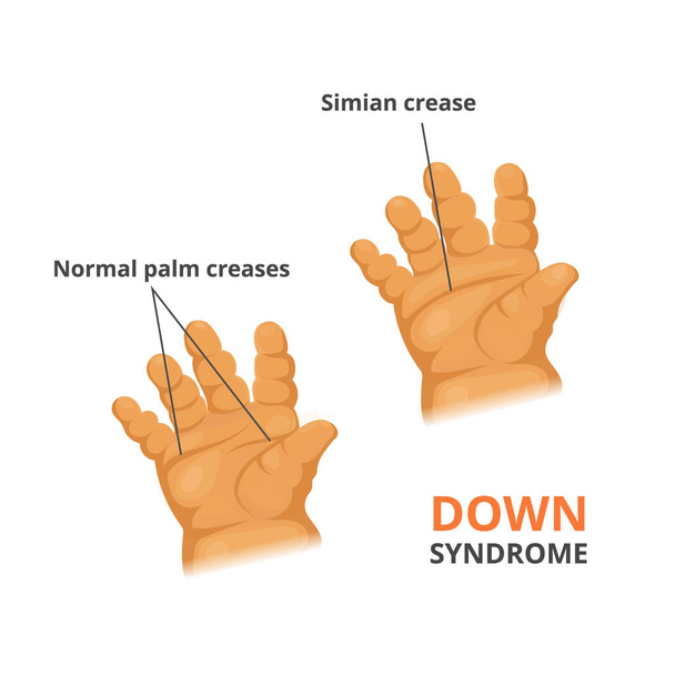 Ilustracja objawów zespołu Downa o nazwie Simian crease w porównaniu z prawidłową anatomią dłoni dziecka - Wektor, obraz