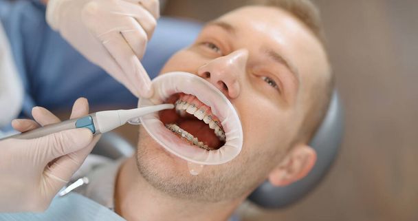 Pacjent z aparatem ortodontycznym podczas leczenia ortodontycznego - Zdjęcie, obraz
