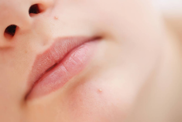 Teenage acne on the chin. Close up face with pimple. Teen problem.  - Photo, Image
