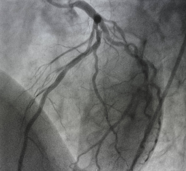 冠血管造影,心臓病のための医療X線.冠動脈疾患. - 写真・画像