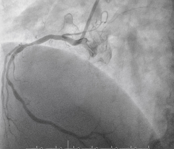 Koronární angiogram, lékařský rentgen na srdeční choroby. Onemocnění věnčitých tepen. - Fotografie, Obrázek