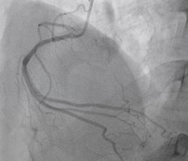 Coronary angiogram , medical x-ray for heart disease. Coronary artery disease. - Photo, Image