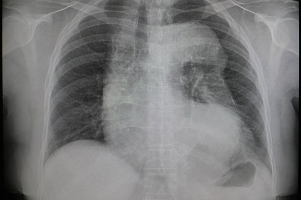 Рентгенівське зображення грудної клітини людини для медичного діагнозу. рентгенівське зображення ненормальне для аорти
. - Фото, зображення