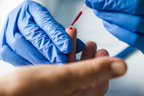 Врач скорой помощи взял образец крови пациента с уколом пальца, используя пипетку, вспышку глобального пандемического кризиса коронавируса COVID-19, процедуру диагностики антител к стрептококку в системе здравоохранения Великобритании - Фото, изображение