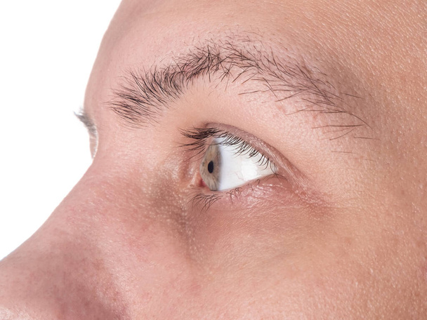 μάτι ενός άνδρα με κερατόκωνο με νοσούντα κερατοειδή κοντινό πλάνο - Φωτογραφία, εικόνα