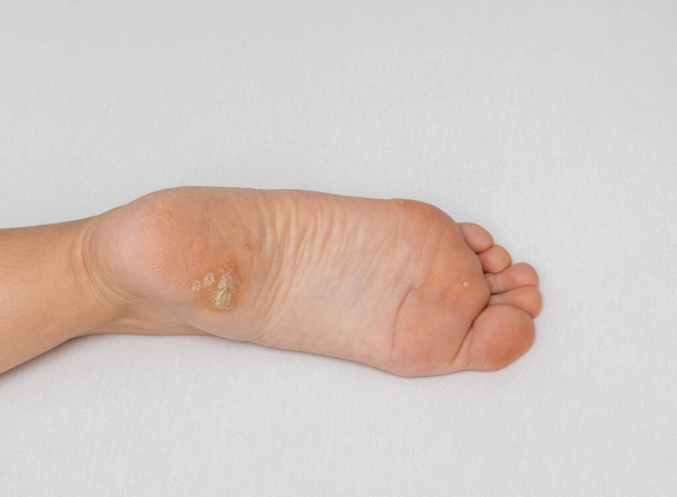 Plantaire wrat van dichtbij op de bodem van een vrouwelijke voethiel veroorzaakt door het humaan papillomavirus, of HPV. - Foto, afbeelding
