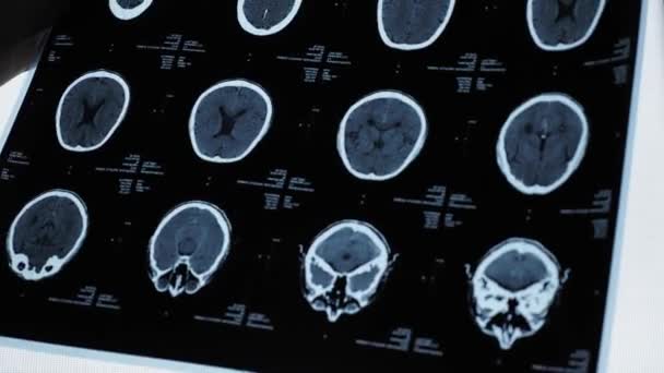 MRI mózgu starszego mężczyzny - Materiał filmowy, wideo