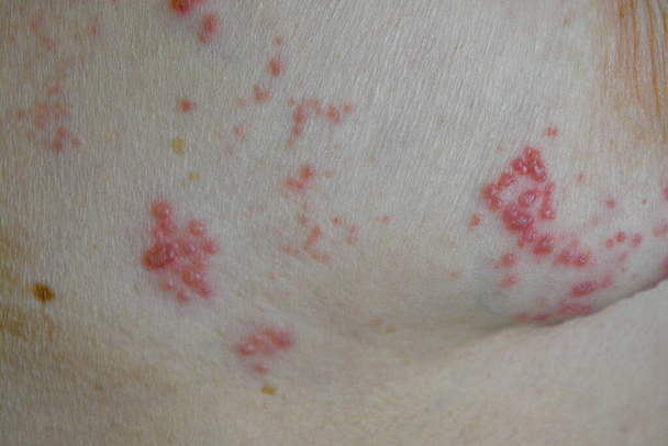 シングル発疹。白い肌に水疱性帯状疱疹ウイルスの水疱 - 写真・画像
