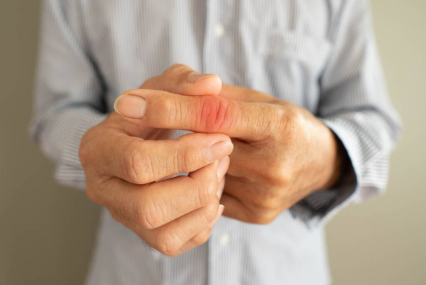 Homme âgé souffrant de douleurs articulaires aux mains et aux doigts avec rougeur. Les causes de la douleur comprennent la polyarthrite rhumatoïde, le syndrome du canal carpien, le doigt déclencheur ou la goutte. Soins de santé et médicaux. - Photo, image