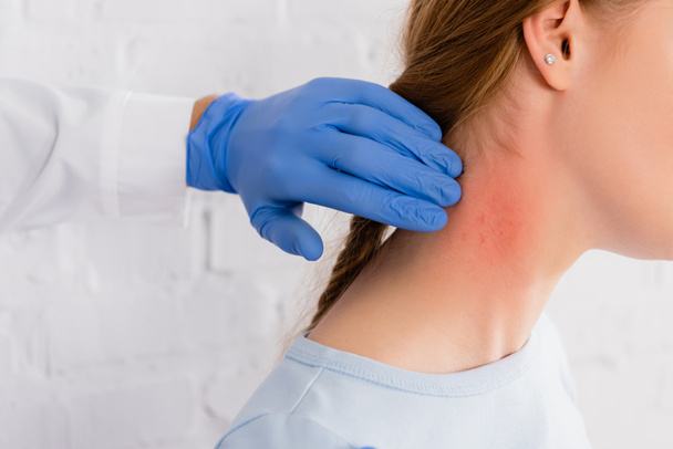 Vista recortada del médico en guante de látex tocando el cuello de la mujer con reacción alérgica  - Foto, imagen